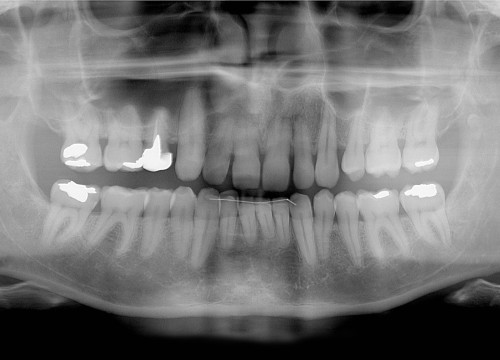 rtg (x-ray)  photo of man teeth as medical background