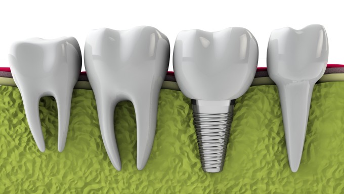 molars and implant in the jaw bone, 3d render