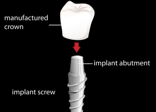 Illustration of a dental implant with crown