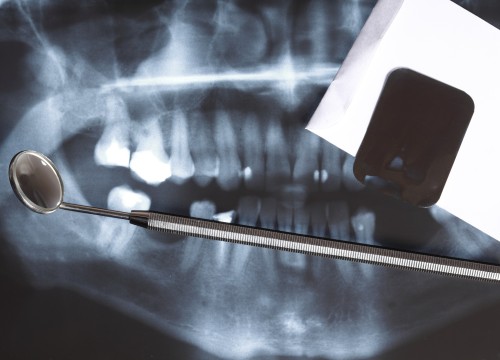 Panoramic x-ray image scan of humans teeth and dental mirror